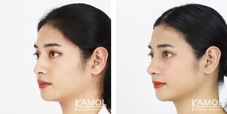 Before & After Revision Rhinoplasty