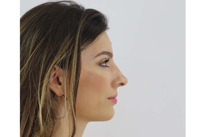 Reviews Revision Rhinoplasty