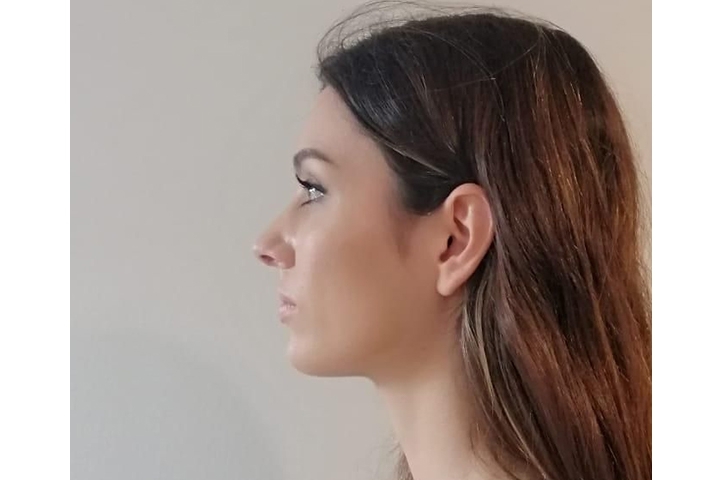 Reviews Revision Rhinoplasty