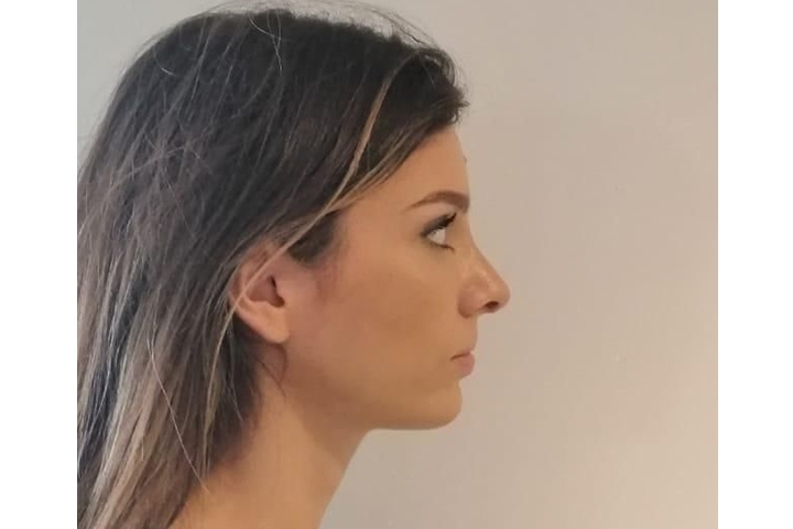 Reviews Revision Rhinoplasty