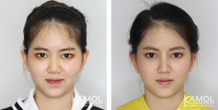 Augmentation Rhinoplasty / Nose Job Surgery Before & After