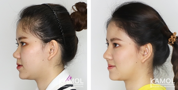 Augmentation Rhinoplasty / Nose Job Surgery Before & After