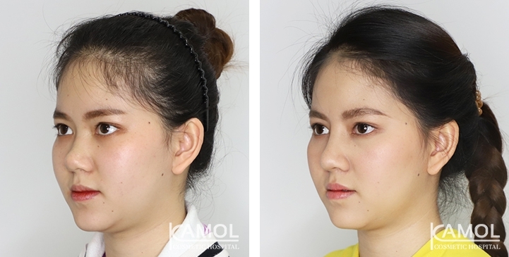 Augmentation Rhinoplasty / Nose Job Surgery Before & After