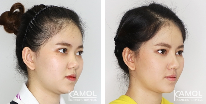 Augmentation Rhinoplasty / Nose Job Surgery Before & After