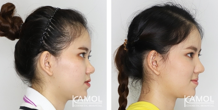 Augmentation Rhinoplasty / Nose Job Surgery Before & After