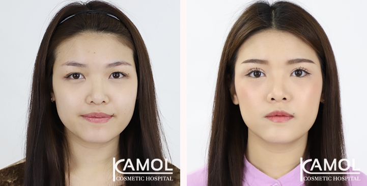 Before and After Blepharoplasty, Eyelid Ptosis