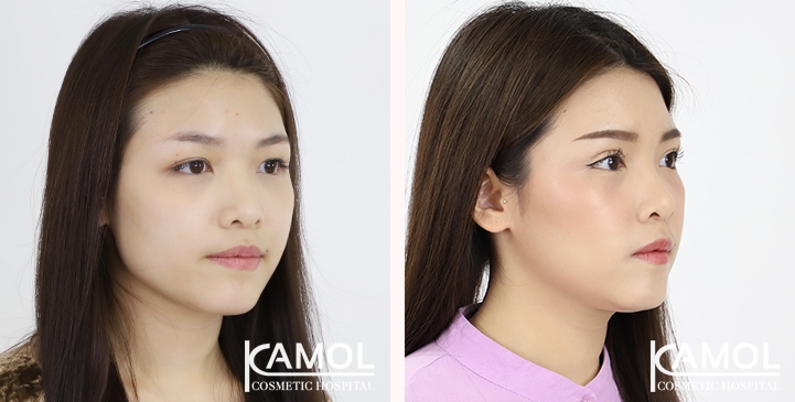 Before and After Blepharoplasty, Eyelid Ptosis