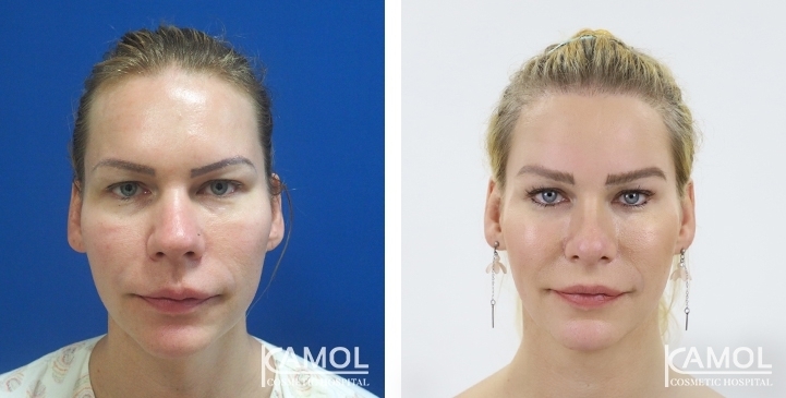 Before & After Face Surgery / Facial contouring