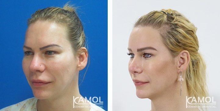 Before & After Face Surgery / Facial contouring