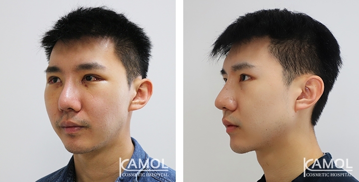 Before & After Jaw Augmentation, Jaw Implant, Mandibular Augmentation