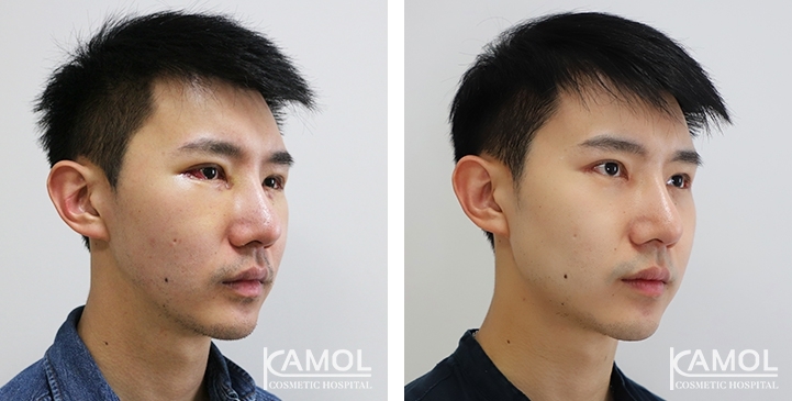 Before & After Jaw Augmentation, Jaw Implant, Mandibular Augmentation