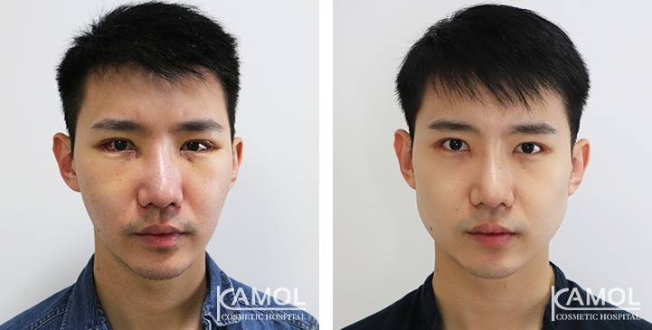 Before & After Jaw Augmentation, Jaw Implant, Mandibular Augmentation