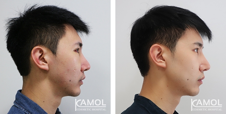 Before & After Jaw Augmentation, Jaw Implant, Mandibular Augmentation