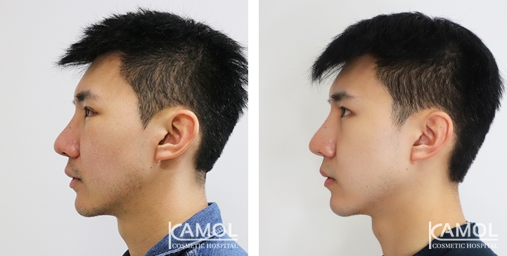 Before & After Jaw Augmentation, Jaw Implant, Mandibular Augmentation