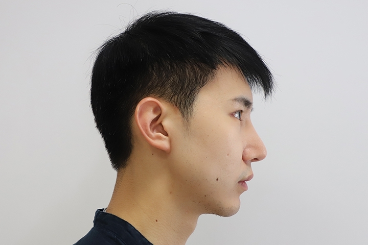 Reviews Jaw Augmentation