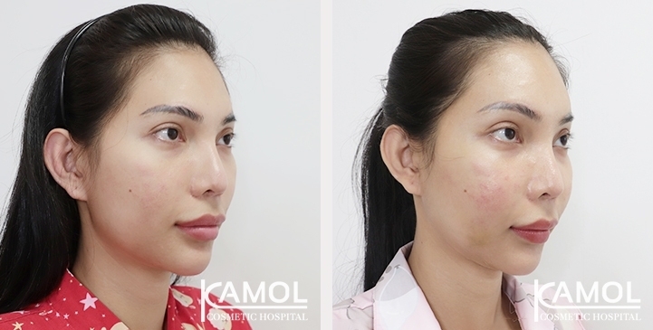 Before & After Cheekbone Augmentation 