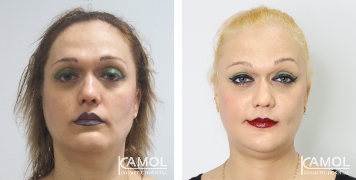 Before & After Chin Reduction Surgery / Genioplasty