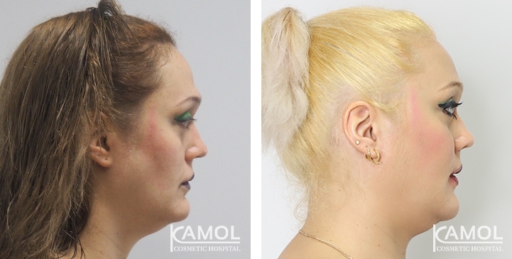 Before & After Chin Reduction Surgery / Genioplasty