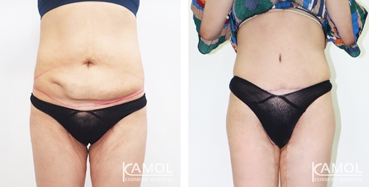 Before & After Tummy Tuck