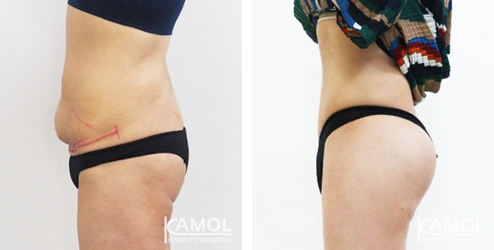 Before & After Tummy Tuck