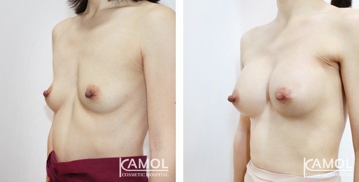 Before and After Breast Augmentation / Breast Implant Surgery