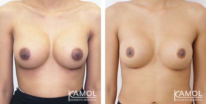 Before and After Breast Implant Revision