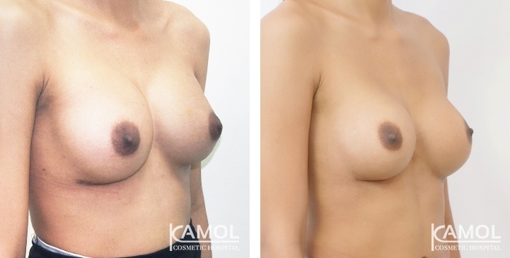 Before and After Breast Implant Revision
