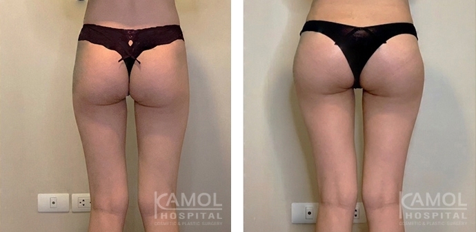 buttock augmentation