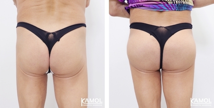 buttock augmentation