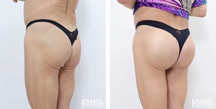 buttock augmentation