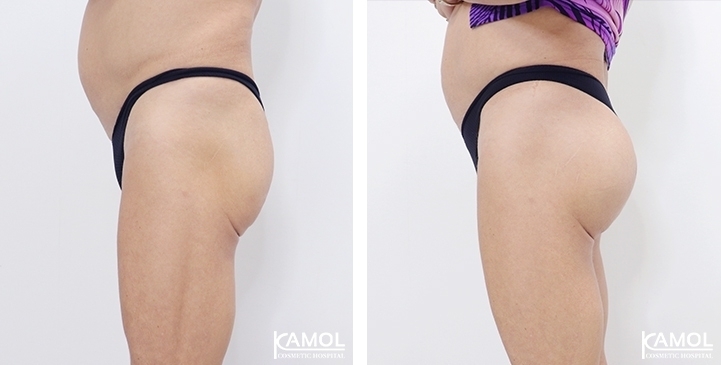 buttock augmentation