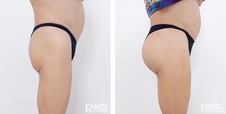 buttock augmentation