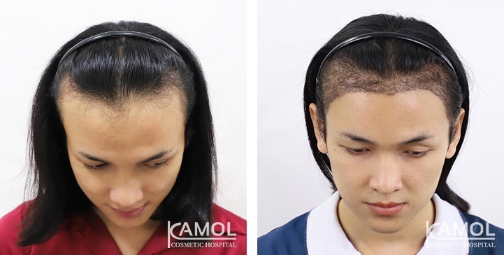 Feminine Hairline