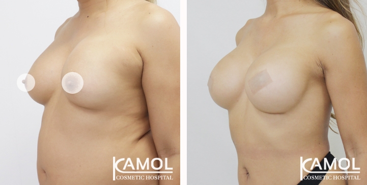 Breast lift and breast reduction after surgery 1 year (4)