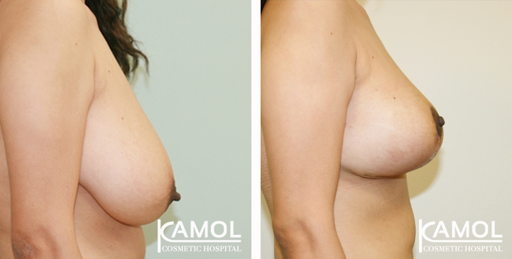 Before and After surgery 1 month Breast Reduction by inverted T-scar