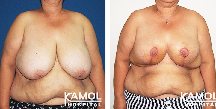 Before and After surgery 2 weeks Breast Reduction