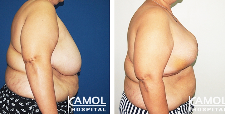 Before and After surgery 2 weeks Breast Reduction