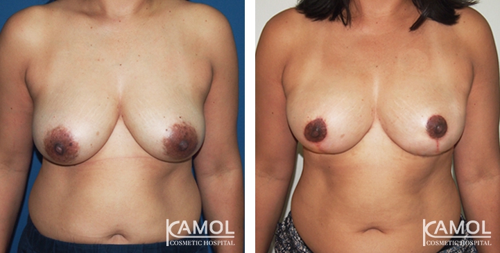 Before and After surgery 2 weeks Breast Reduction by inverted T-scar