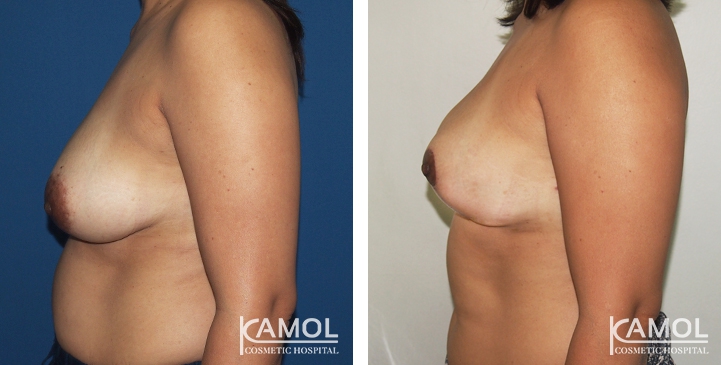 Before and After surgery 2 weeks Breast Reduction by inverted T-scar