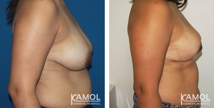 Before and After surgery 2 weeks Breast Reduction by inverted T-scar