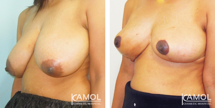 Before and After surgery 1 month Breast Reduction by inverted T-scar