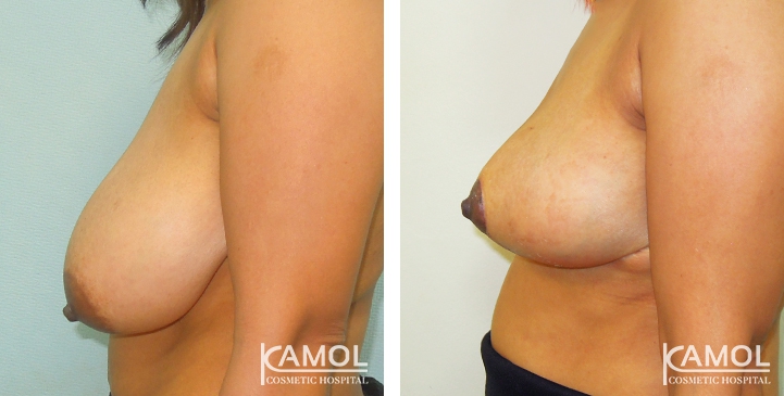 Before and After surgery 1 month Breast Reduction by inverted T-scar