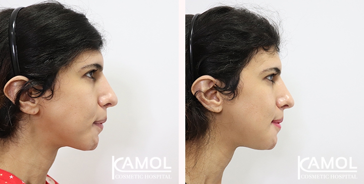 Chin Reduction | Kamol Cosmetic Hospital