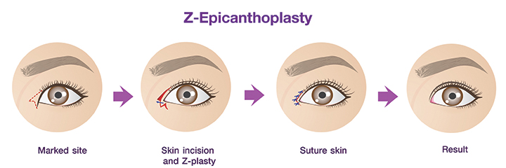 Z-Epicantoplasty_procedure