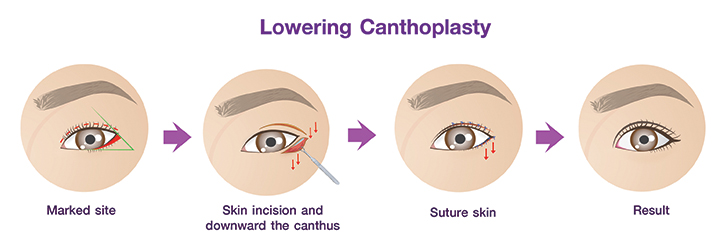 Lowering_Canthoplasty_procedures.