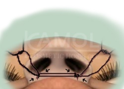 Alarplasty with Septoplasty