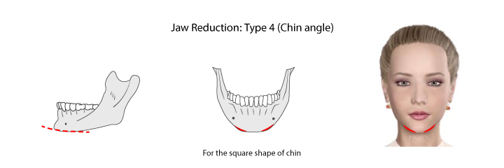  Shows jaws reduction types 4: for the square shape of the chin.