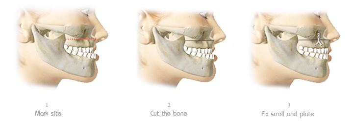การผ่าตัดเลื่อนขากรรไกรบน 