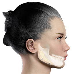 Jaw Augmentation, Jaw Implant, Mandibular Augmentation