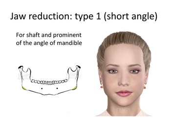 riduzione della mascella ad angolo corto, per angoli mandibolari prominenti